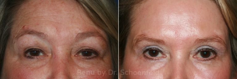 brow-lift-before-after-768x256