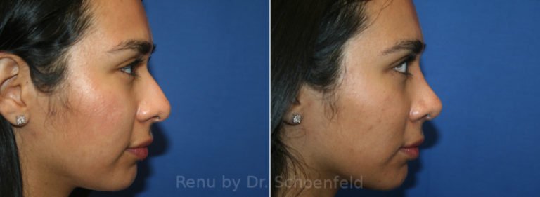 patient-13404-rhinoplasty-before-after-1-768x281