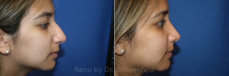 patient-13721-rhinoplasty-before-after-2-768x256 (1)
