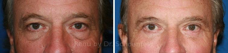 patient-7215-blepharoplasty-before-after
