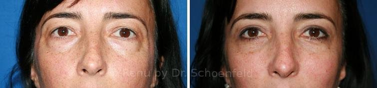patient-7232-blepharoplasty-before-after-18