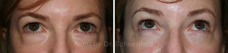 patient-7232-blepharoplasty-before-after-22