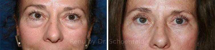 patient-7232-blepharoplasty-before-after-26