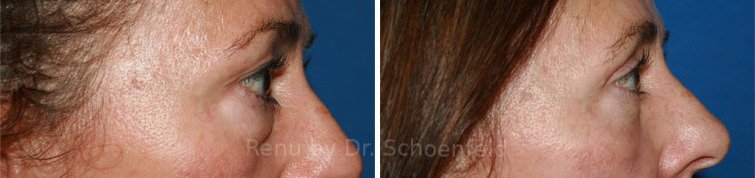 patient-7265-blepharoplasty-before-after-1