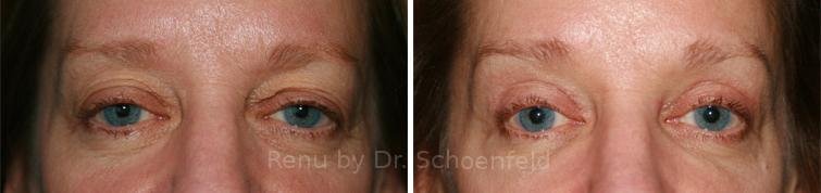patient-7270-blepharoplasty-before-after-14
