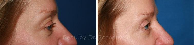 patient-7270-blepharoplasty-before-after-16