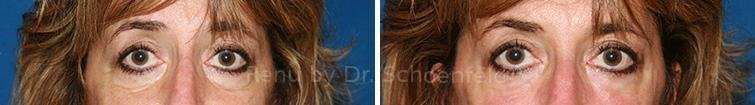 patient-7343-dermal-filler-before-after-10