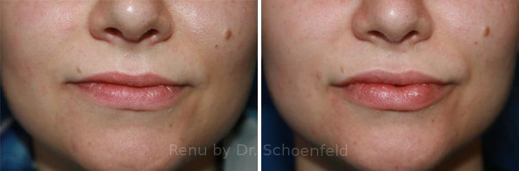 patient-7343-dermal-filler-before-after-4