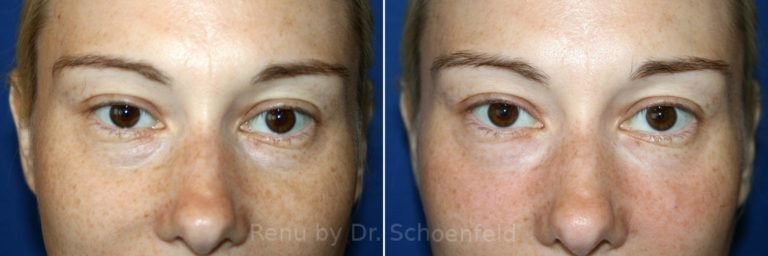 patient-7343-dermal-filler-before-after-6-768x256