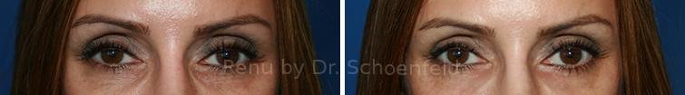 patient-7360-dermal-filler-before-after-11