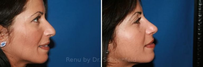 patient-7586-rhinoplasty-before-after-1-768x255