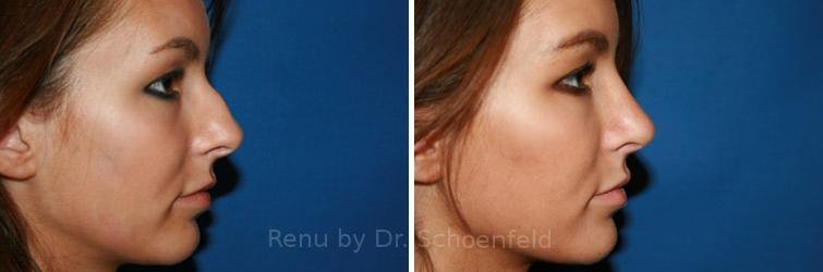 patient-7706-rhinoplasty-before-after-33