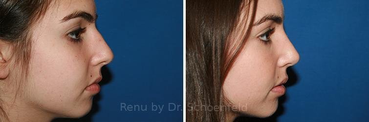 patient-9888-rhinoplasty-before-after-13