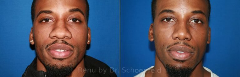 patient-9888-rhinoplasty-before-after-16-768x249