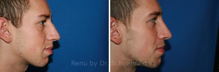 patient-9888-rhinoplasty-before-after-19