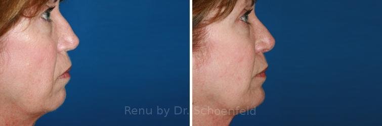 patient-9888-rhinoplasty-before-after-24