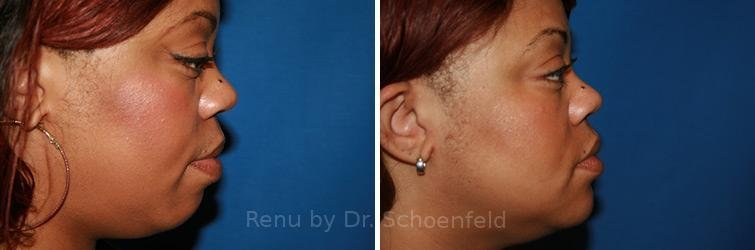 patient-9888-rhinoplasty-before-after-32