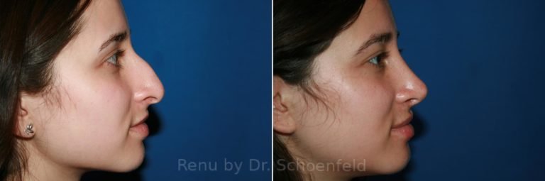 patient-9888-rhinoplasty-before-after-4-768x255