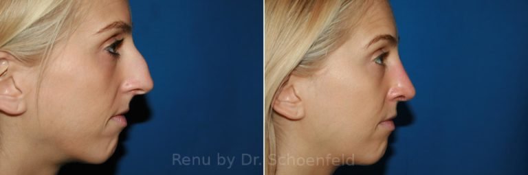 patient-9888-rhinoplasty-before-after-6-768x255