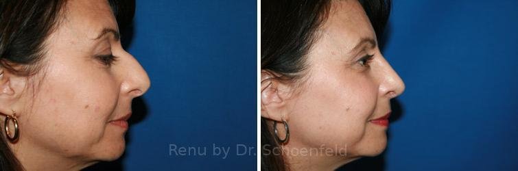 patient-9888-rhinoplasty-before-after-9 (1)