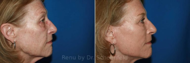 patient-9902-facelift-before-after-1-768x255