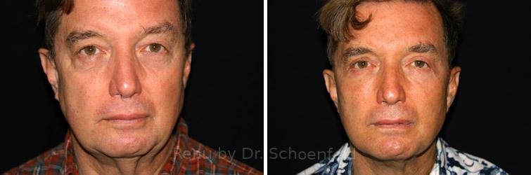 patient-9902-facelift-before-after-11