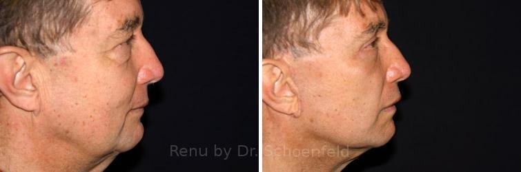 patient-9902-facelift-before-after-12