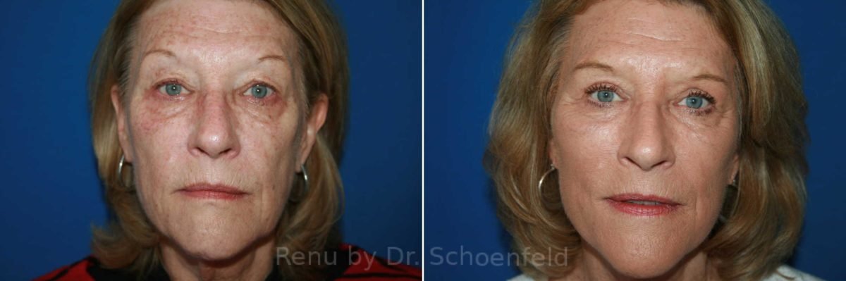 patient-9902-facelift-before-after-1200x399