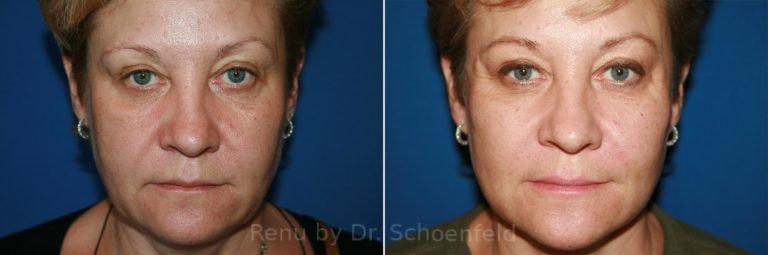 patient-9902-facelift-before-after-2-768x255
