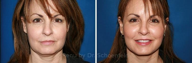 patient-9902-facelift-before-after-5