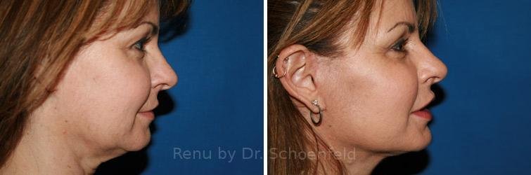 patient-9902-facelift-before-after-6