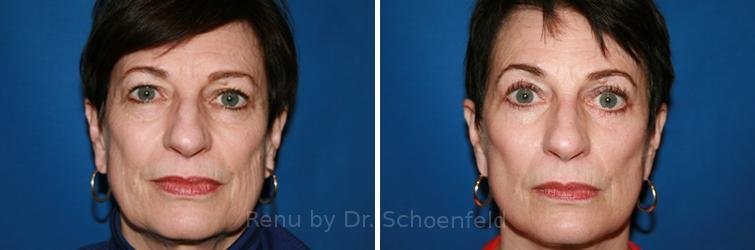 patient-9902-facelift-before-after-7