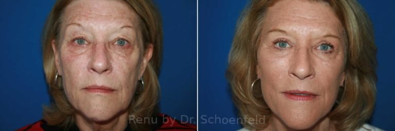 patient-9902-facelift-before-after-768x255