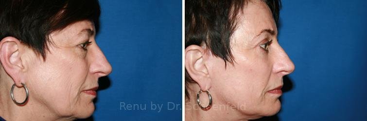 patient-9902-facelift-before-after-8