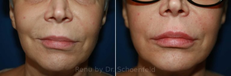 patient-9967-dermal-filler-before-after-11-768x255