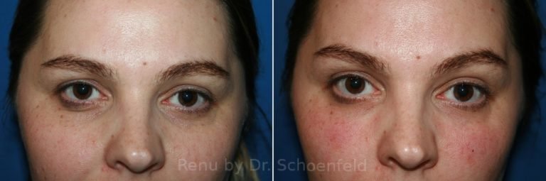 patient-9967-dermal-filler-before-after-14-768x255