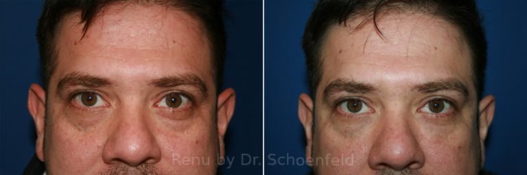 patient-9967-dermal-filler-before-after-15-768x255