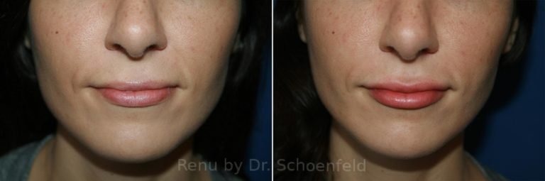 patient-9967-dermal-filler-before-after-17-768x255