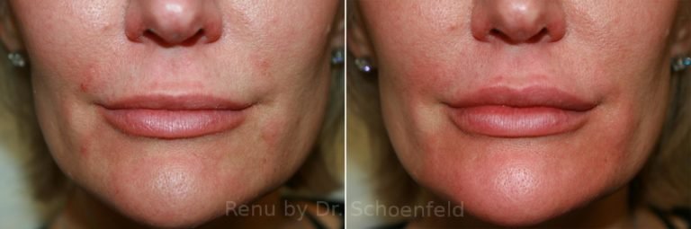 patient-9967-dermal-filler-before-after-18-768x255