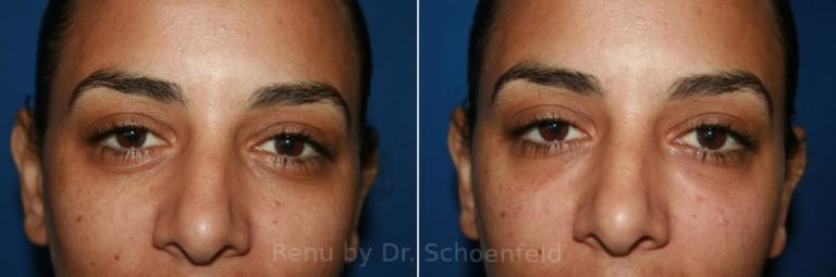 patient-9967-dermal-filler-before-after-19-768x255